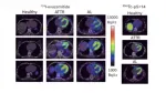 PET-CT imaging of I-124 evuzamitide and SPECT-CT imaging of Tc99m p5+14 showed radiotracer uptake in both AL and ATTR amyloid throughout the myocardium. Image courtesy of ASNC