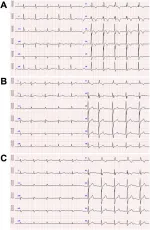 Electrocardiograms acquired on admission (A) and at two (B) and four (C) years thereafter. Panels A, B, and C show sinus rhythm and complete right bundle branch block. The R-wave amplitude in lead V5 progressively decreased, with values of 1.9 mV, 1.4 mV, and 1.0 mV for Panels A, B, and C, respectively.