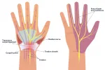 The median nerve runs through the carpal tunnel. When the median nerve is compressed, it can cause feelings of pain, tingling, or numbness throughout much of the hand. 