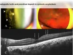 Pseudopodia lentis and preretinal deposit in systemic amyloidosis