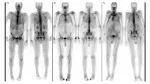 amyloidosis