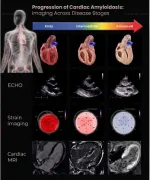 amyloidosis