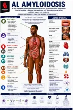 amyloidosis