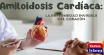 amyloidosis