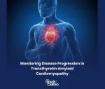 amyloidosis