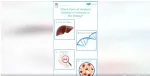 amyloidosis
