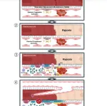 amyloidosis