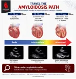 amyloidosis