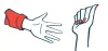 amyloidosis