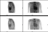 amyloidosis