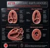 amyloidosis