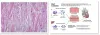 amyloidosis